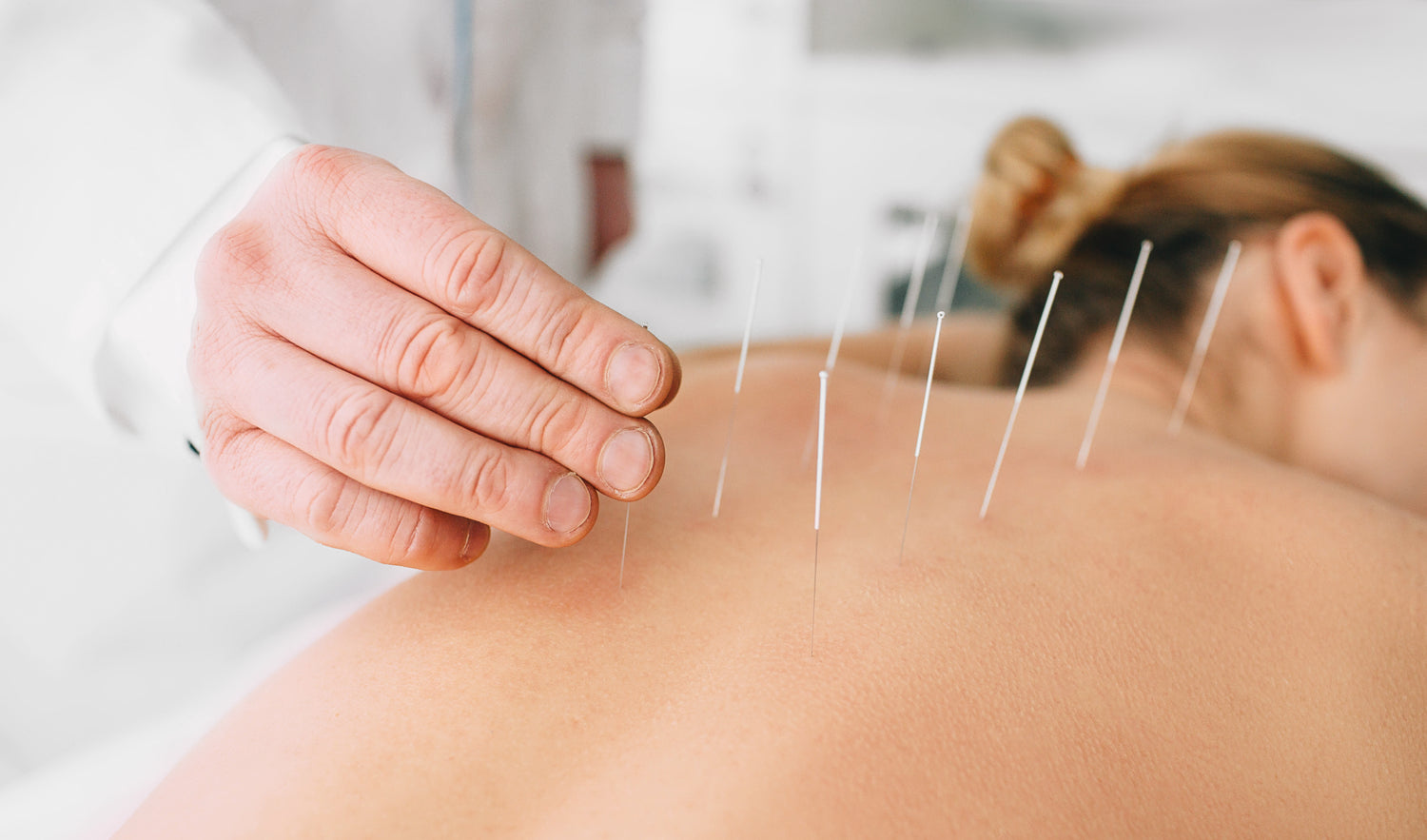 L’acupuncture comme solution pour dormir